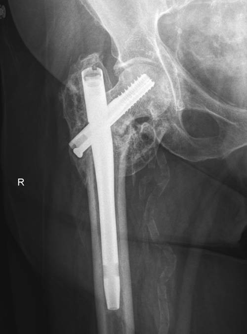 Medial pelvic migration of the lag screw in a short gamma nail after