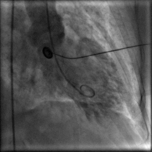 Apical ballooning syndrome complicated by acute severe mitral