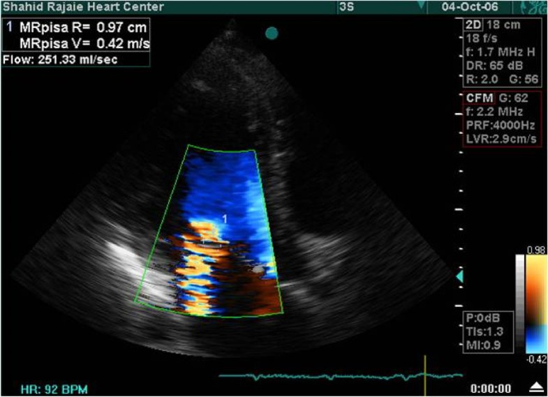 Echocardiographic evaluation of mitral geometry in functional mitral