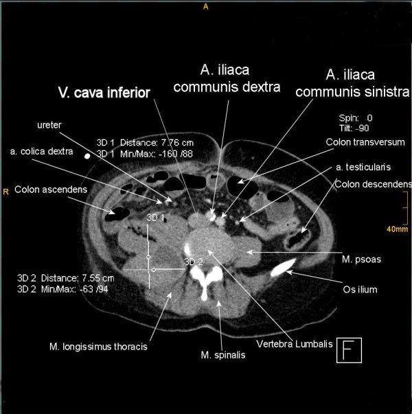 Intra-abdominal hypertension due to heparin - induced ... abdominal aorta artery diagram 