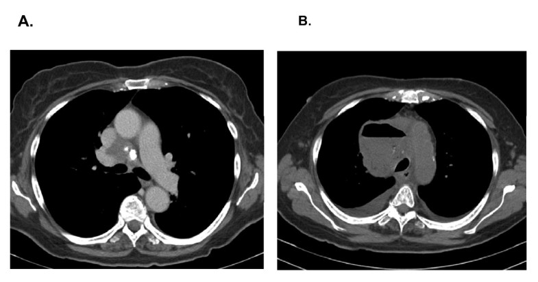 Mediastinal abscess after endobronchial ultrasound with transbronchial ...