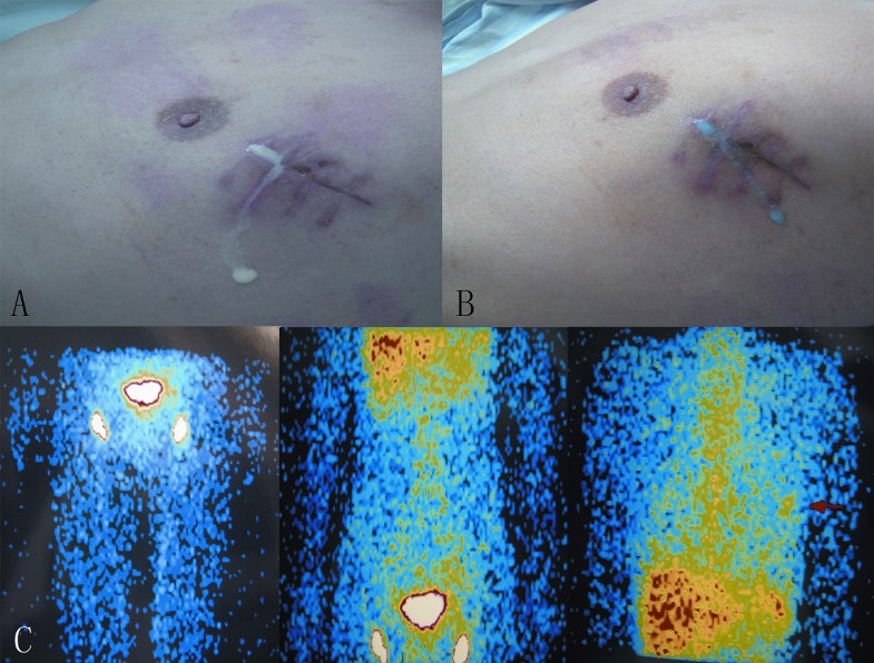 Chyle leakage in port incision after videoassisted thoracoscopic surgery case report Journal