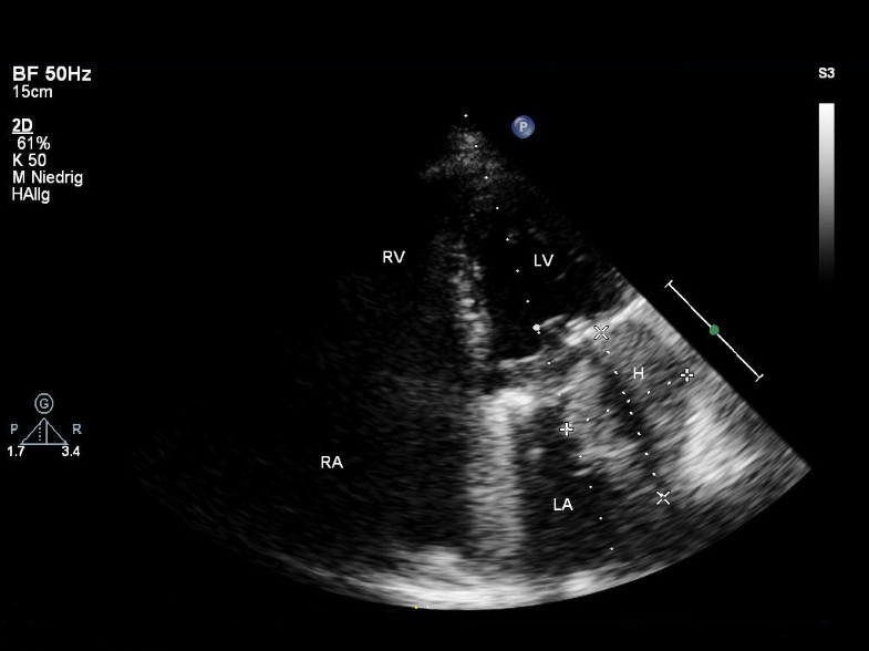 Conservative treatment of a left atrial intramural hematoma after left atrial thrombus resection ...