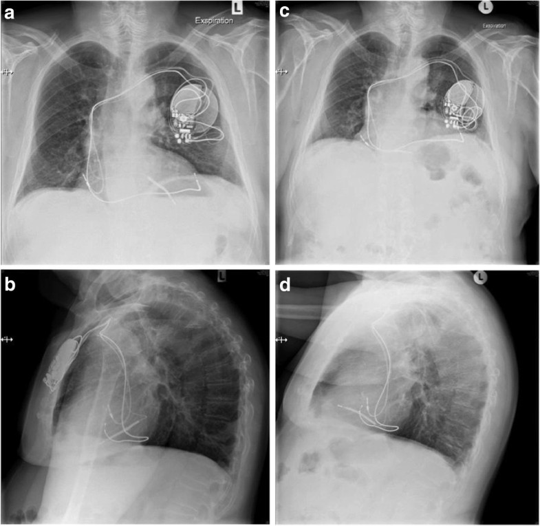 Double left ventricular pacing following accidental malpositioning of the right ventricular ...