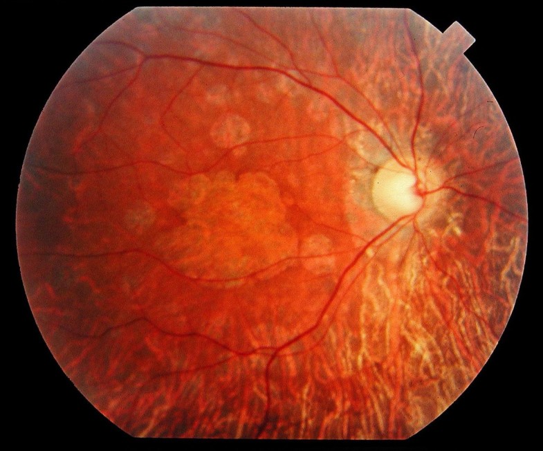 Cone rod dystrophies Journal of Rare Diseases Full Text