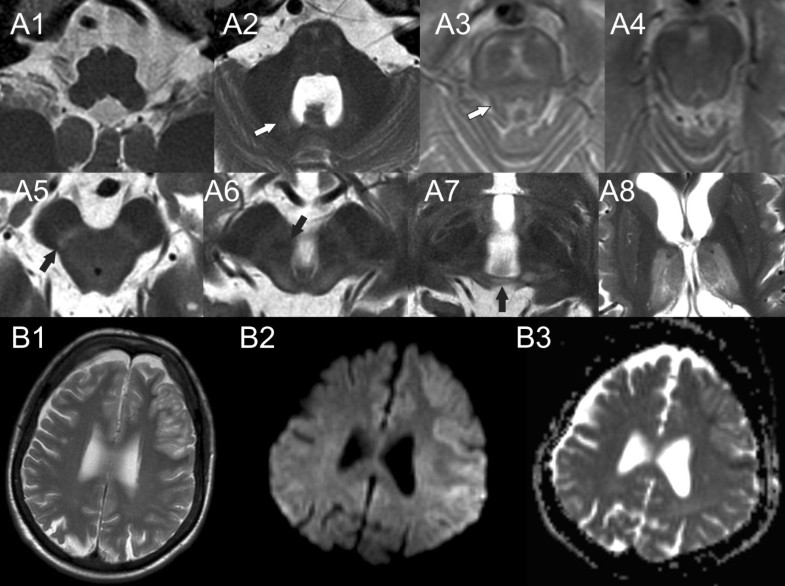 MRI characterisation of adult onset alphamethylacylcoA racemase
