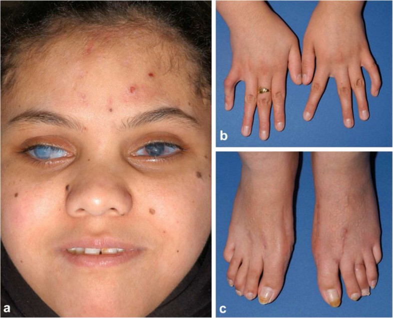 Brittle cornea syndrome recognition, molecular diagnosis and