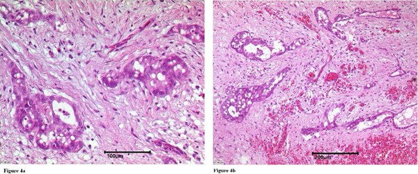 Primary malignant pericardial mesothelioma - a rare cause of