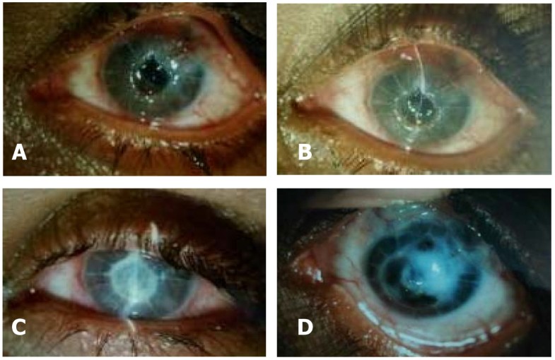 Spontaneous corneal melting in pregnancy a case report Journal of