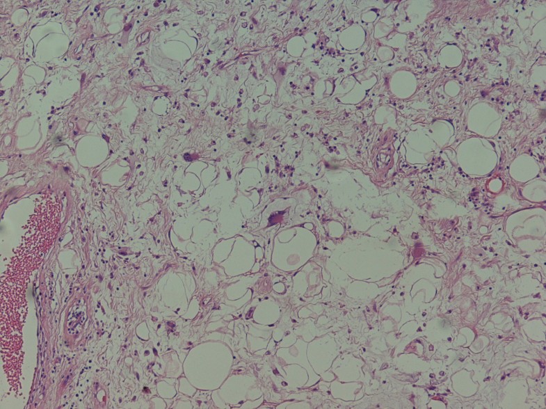 primary mediastinal liposarcoma: a case report