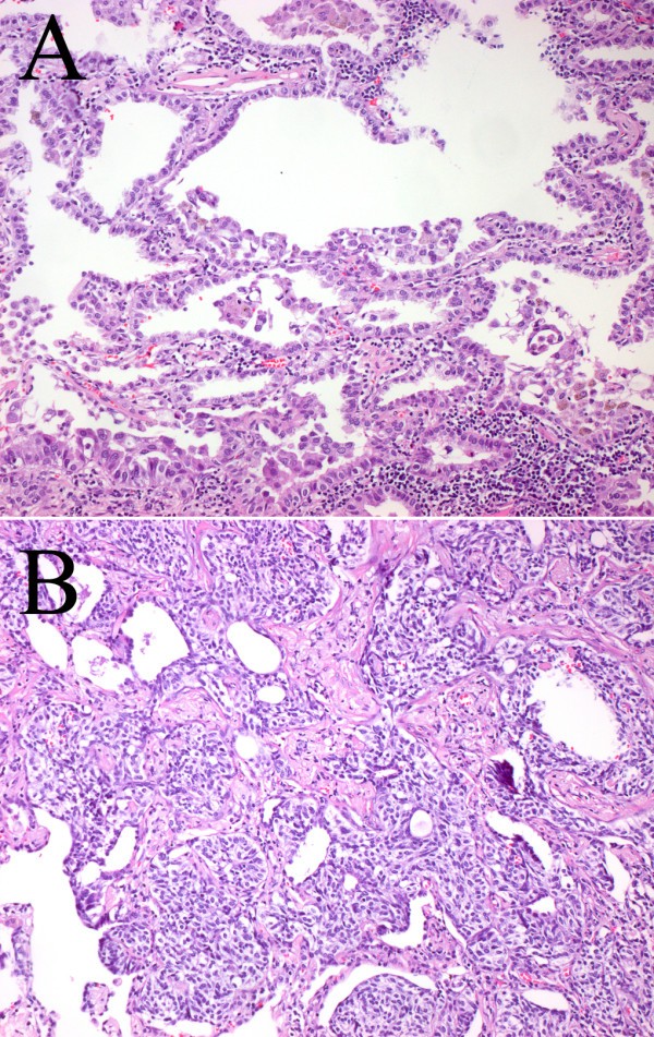 diptic diffuse idiopathic