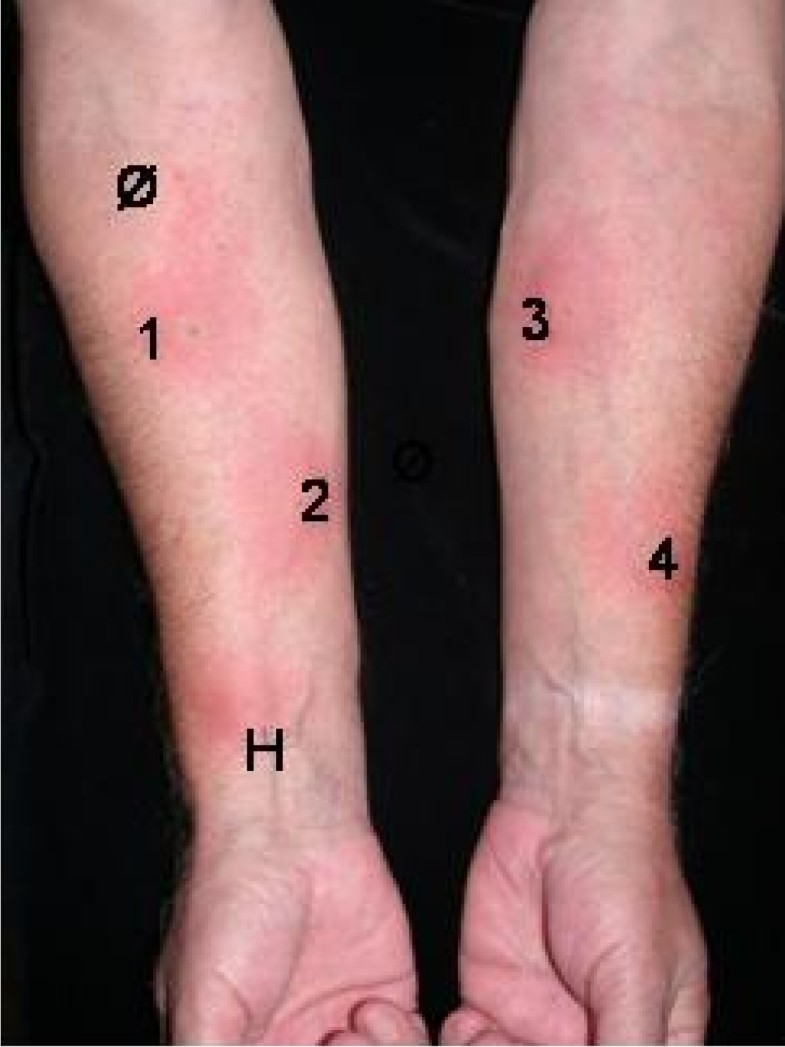 Successful desensitization with human insulin in a patient with an