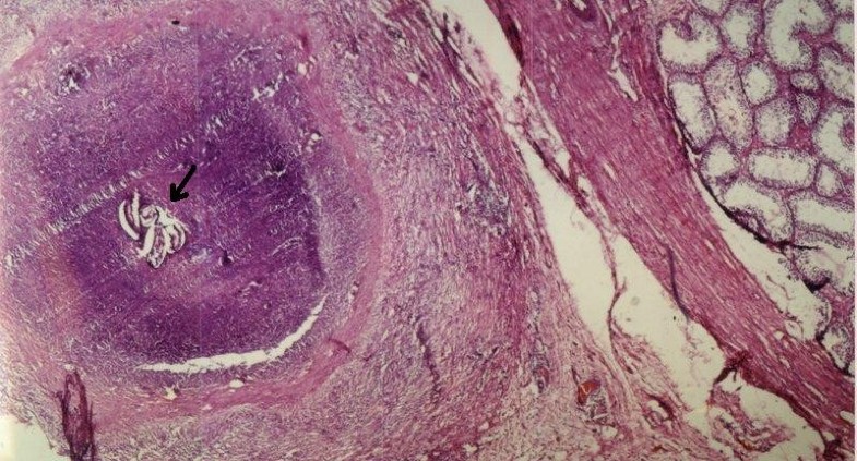 case report foreign body a testicular of mimicking granuloma the Filarial tunic case report foreign body a testicular of mimicking granuloma the Filarial tunic