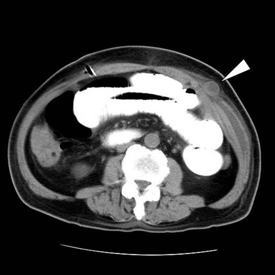 Port site herniation of the small bowel following laparoscopyassisted