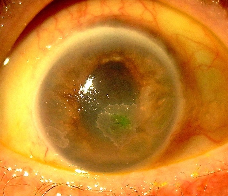 Optic atrophy, necrotizing anterior scleritis and keratitis presenting in association with