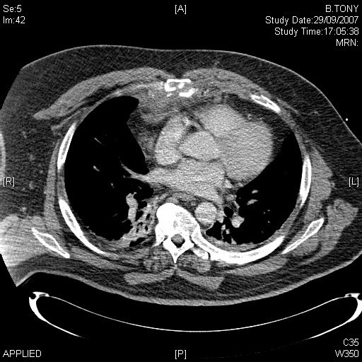 Airbagrelated chest wall burn as a marker of underlying injury a case