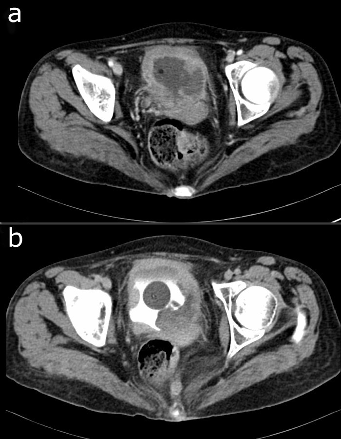 Primary of the urinary bladder following cyclophosphamide