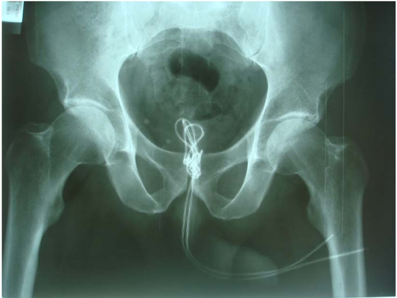 Electrical wire as a foreign body in a male urethra: a case report