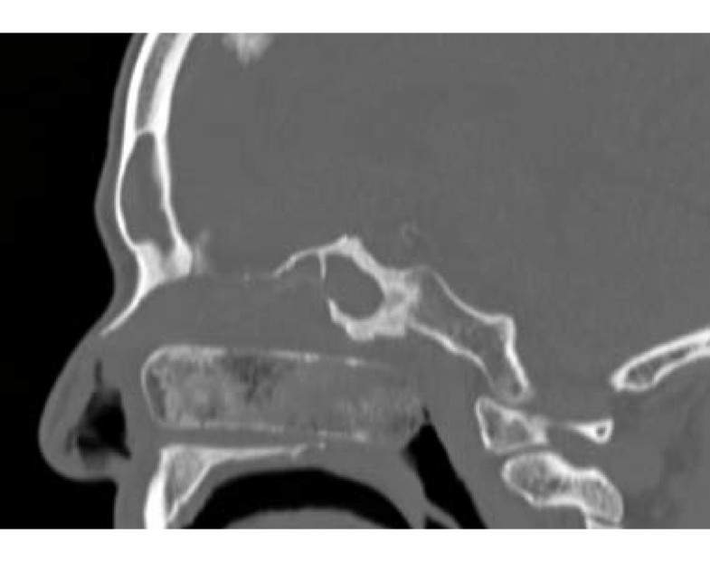 Chronic Sinusitis Unspecified The Webs Free 2021 Icd10