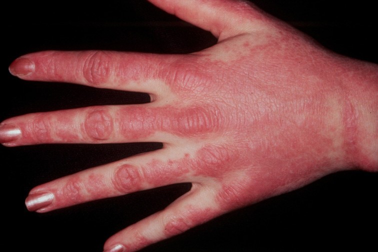 Acute lyme infection presenting with amyopathic dermatomyositis and