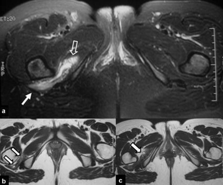 Persistent sciatica induced by quadratus femoris muscle tear and