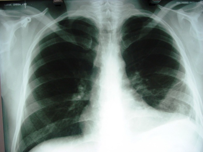 Lung Contusion And Cavitation With Exudative Plural Effusion Following Extracorporeal Shock Wave 