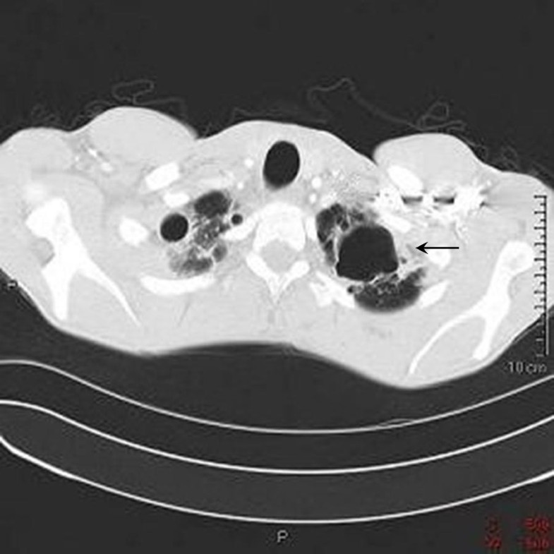 "Bong lung" in cystic fibrosis a case report Journal of Medical Case