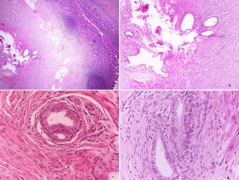 Acute appendicitis caused by endometriosis a case report Journal of