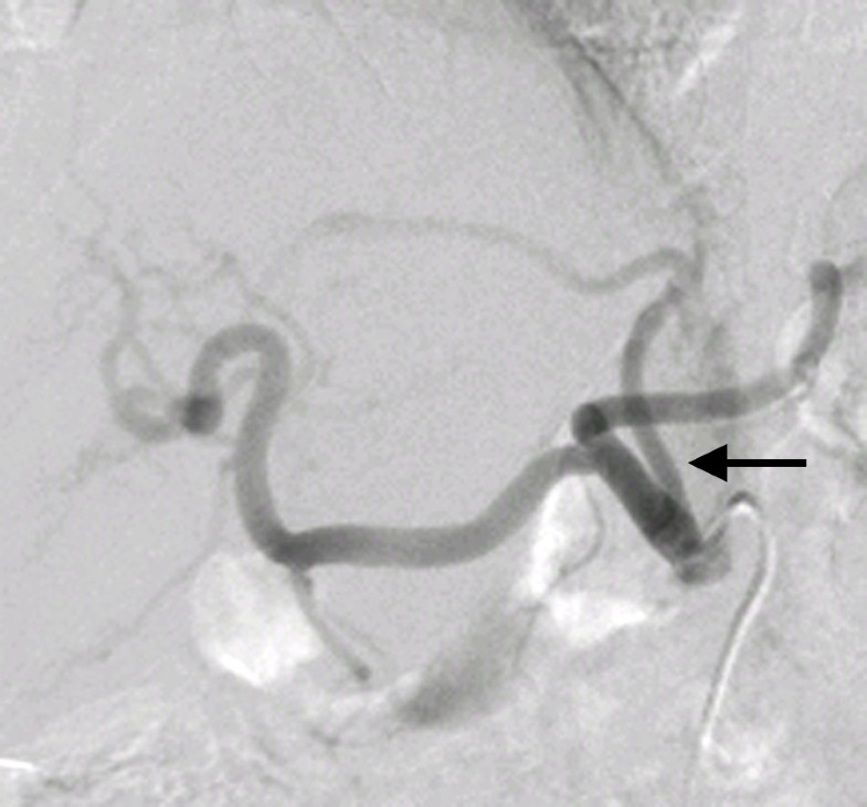 Catheterization and embolization of a replaced left hepatic artery via