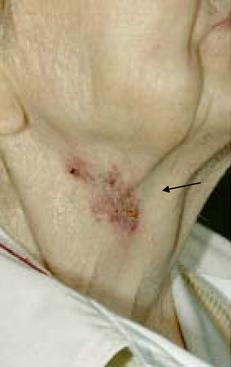 Recurrent neck abscesses due to cervical tuberculous lymphadenopathy in