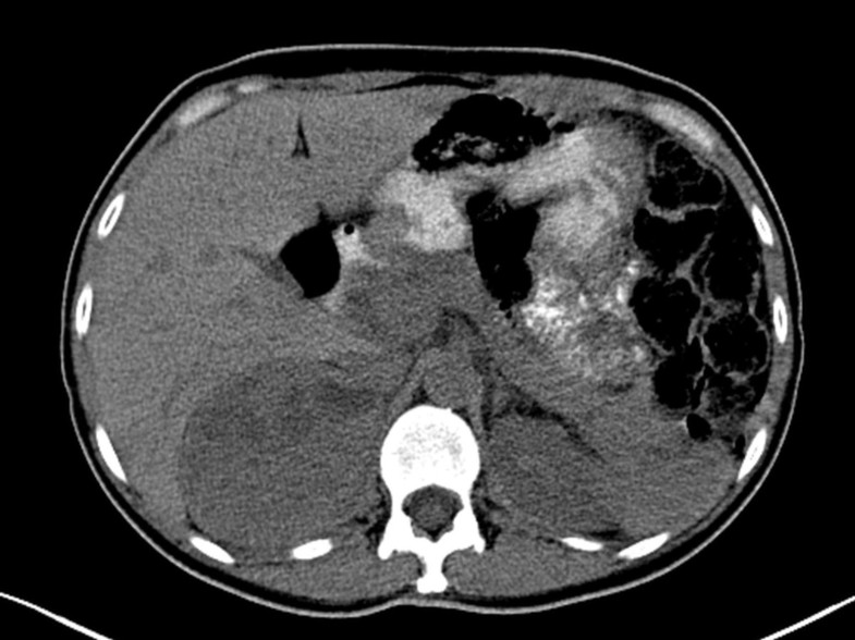 Pheochromocytoma presenting as recurrent urinary tract infections : a