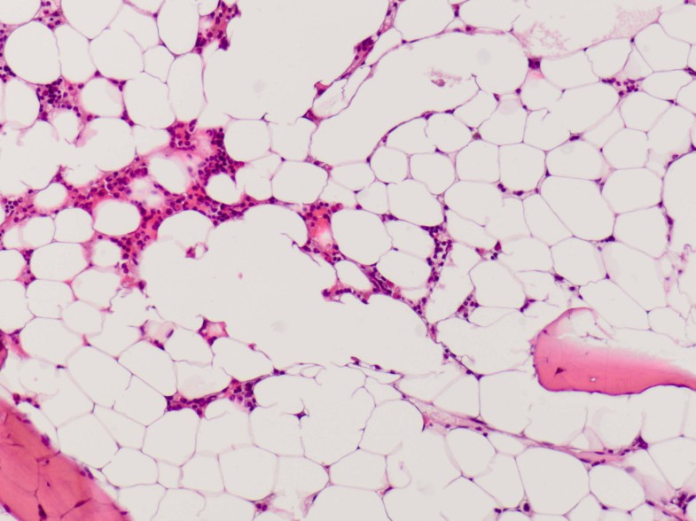 Management of aplastic anemia in a woman during pregnancy a case