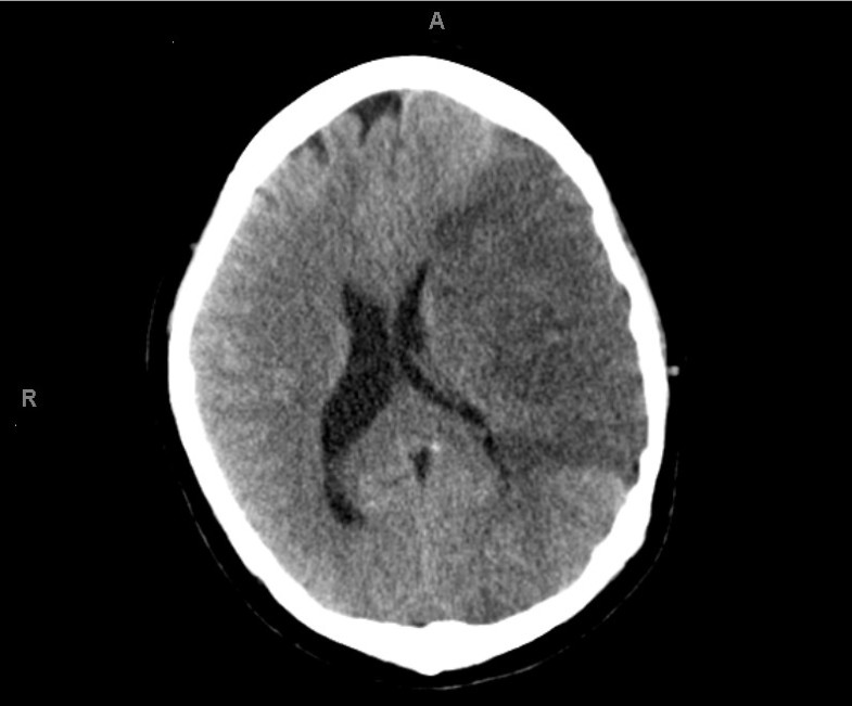 Management of aplastic anemia in a woman during pregnancy: a case ...