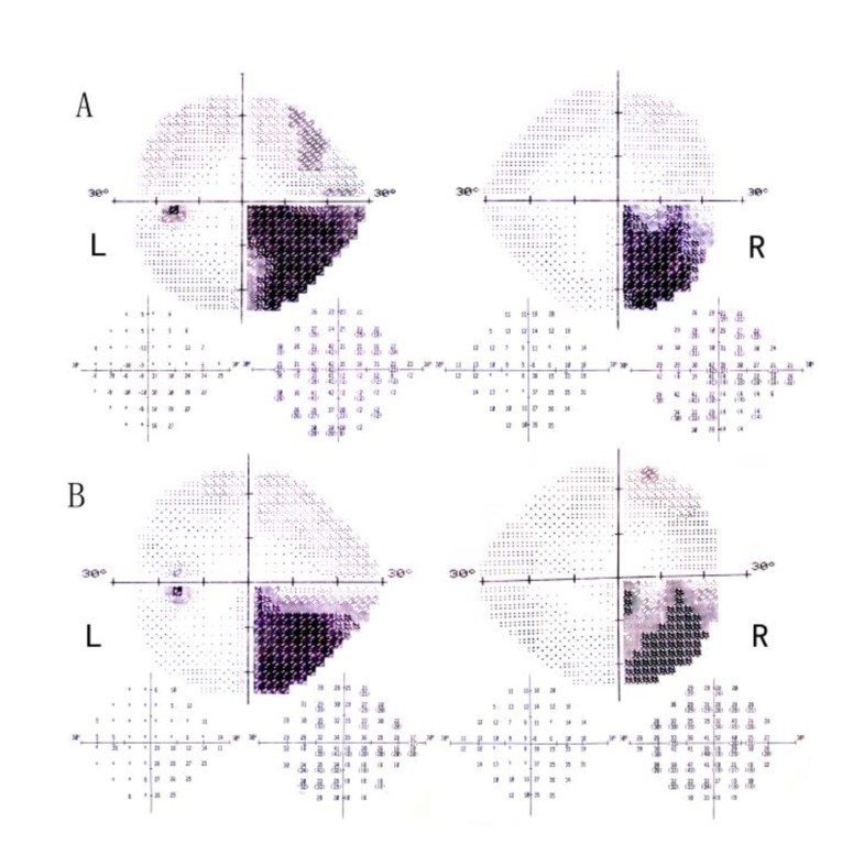 Homonymous Quadrantanopsia as the First Manifestation of Cerebral