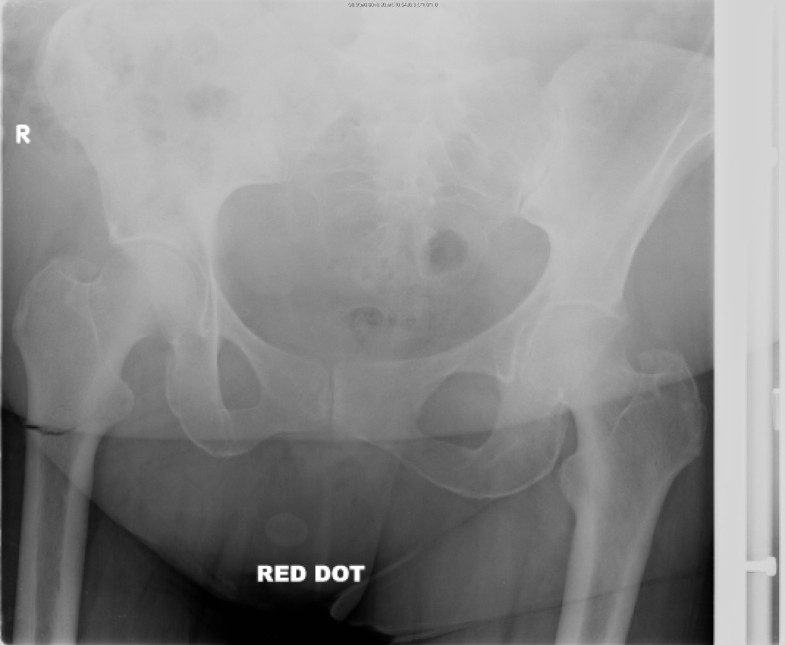 Spontaneous transverse subtrochanteric femoral fracture with