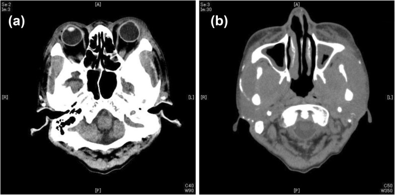 Tumefactive fibroinflammatory lesion presenting with head and neck ...