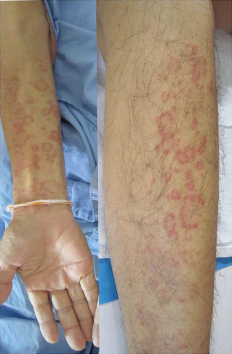 Annular leukocytoclastic vasculitis associated with antituberculosis