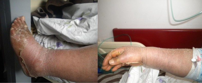 mercury poisoning symptoms mercury poisoning symptoms