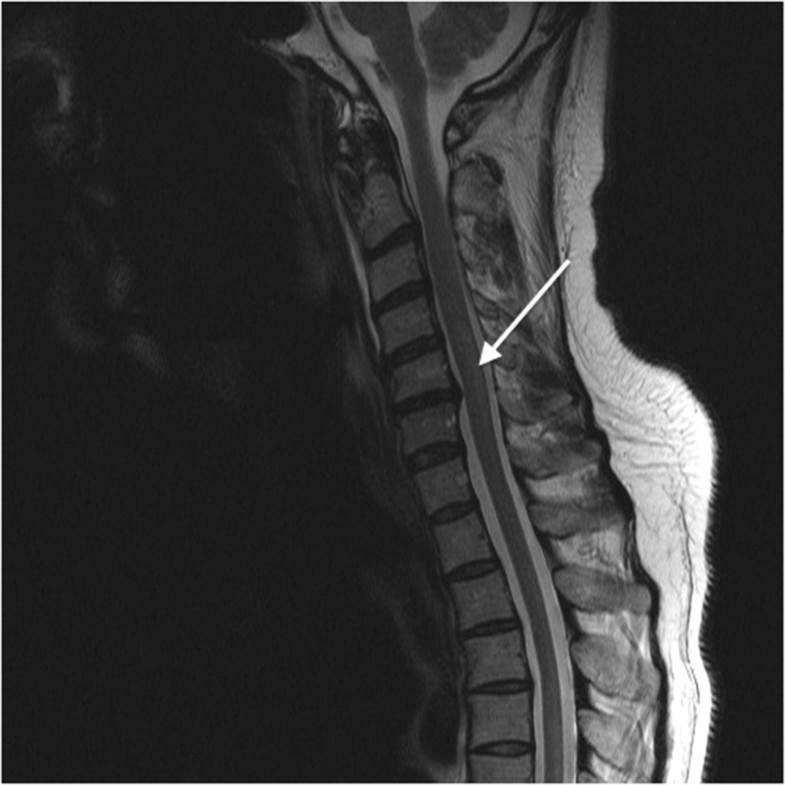 Vitamin B12 deficiency with combined hematological and neuropsychiatric