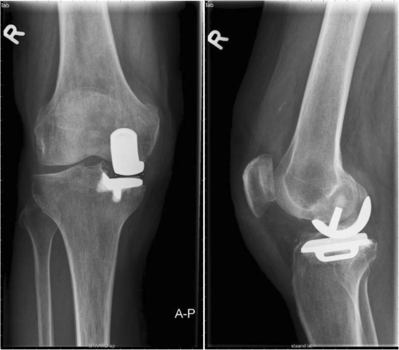 Femoral component failure in the Oxford knee