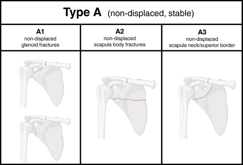 Scapula fractures in complex shoulder injuries and floating shoulders