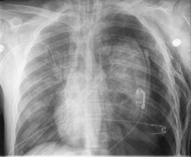pulmonary flutter valve pulmonary flutter valve