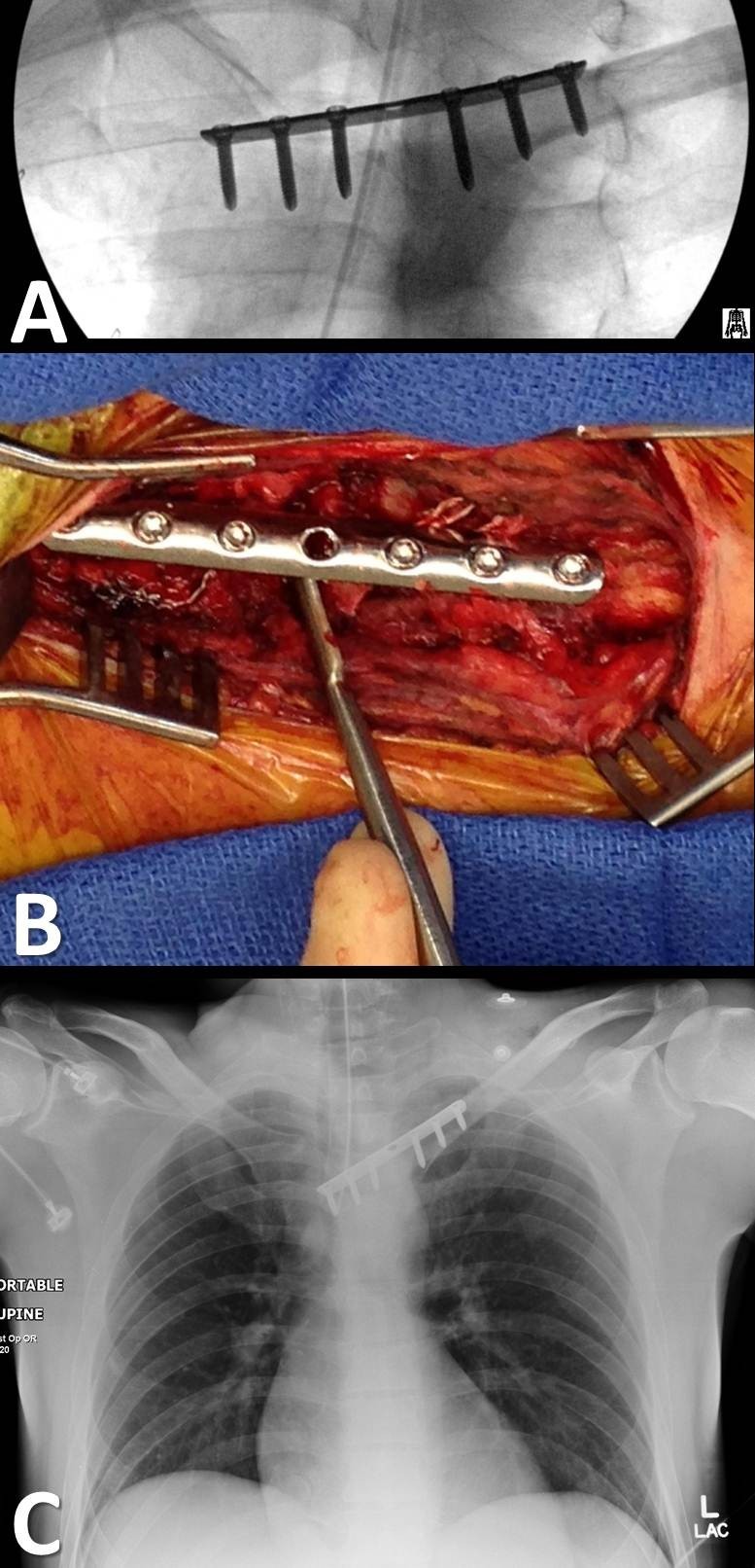 Safe surgical technique: reconstruction of the sternoclavicular joint