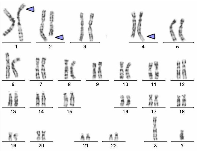 Further delineation of complex chromosomal rearrangements in fertile ...