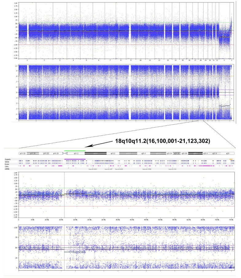 Low grade mosaic for a complex supernumerary ring chromosome 18 in an
