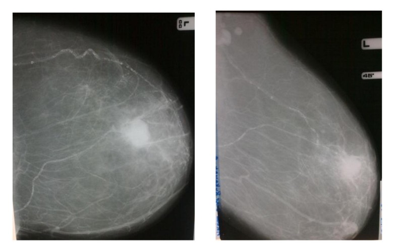 Mammograms And Breast Arterial Calcifications Looking Beyond Breast Cancer A Preliminary