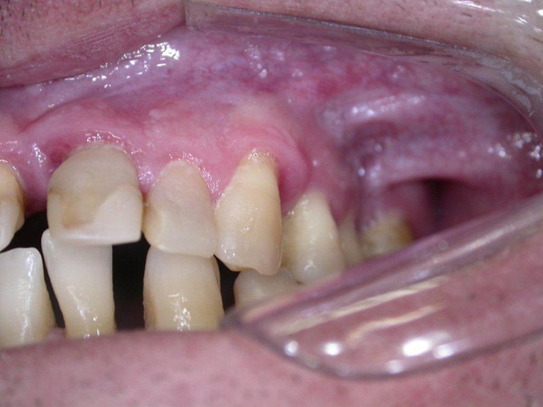 Peripheral calcifying cystic odontogenic tumour of the maxillary ...