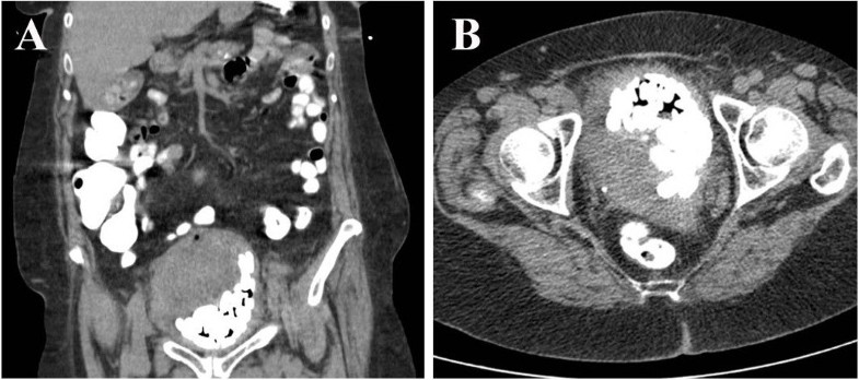 Squamous cell carcinoma of the bladder in a female ...