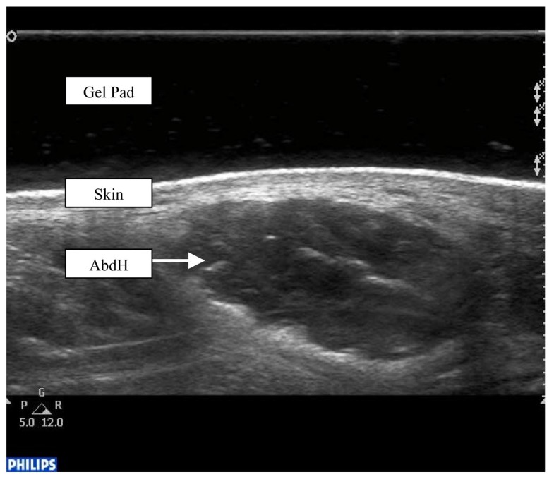 Ultrasound evaluation of the abductor hallucis muscle: Reliability
