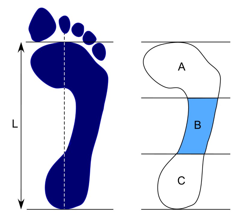 Foot posture in people with medial compartment knee osteoarthritis ...